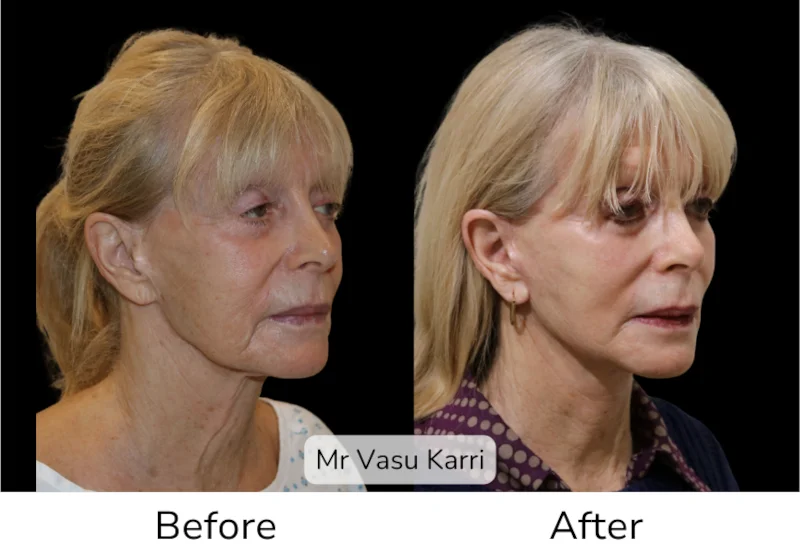 Facelift Patient 6 View 2